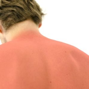 21426473 - sunburned male back. isolated over white background.